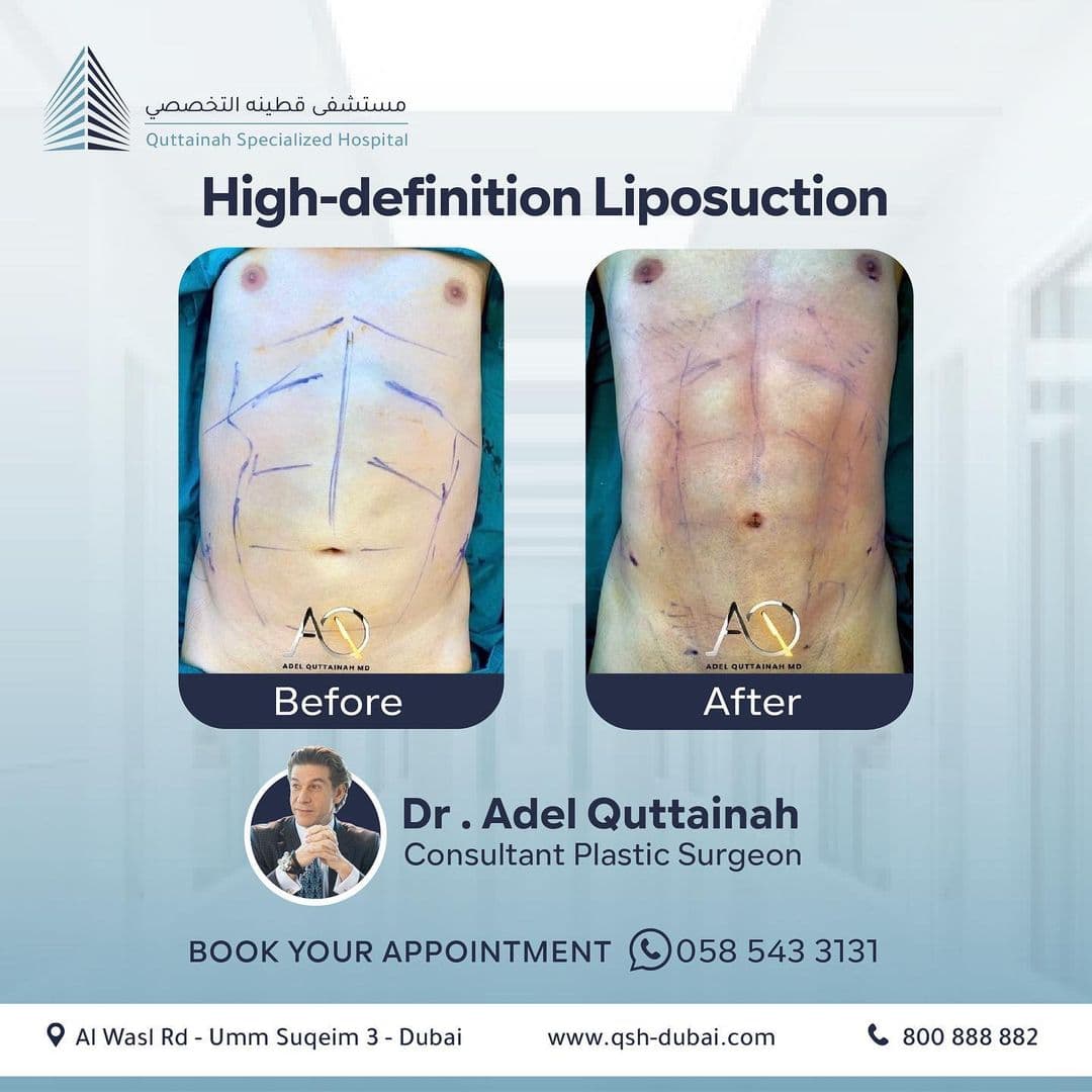 Tummy Tuck Before and After